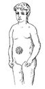 Umbilical hernia bandage. Illustration of the 19th century.