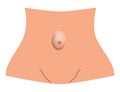 Umbilical hernia. intestinal hernia. Infographics. Vector illustration on isolated background.