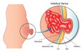 Umbilical hernia