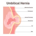 Umbilical hernia. Part of the intestine bulges through the opening