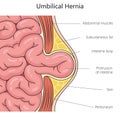 Umbilical hernia structure diagram medical science