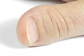 Unattractive thumb on white background