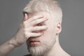 Uncommon albino guy closing his face with palm, looking with one eye through fingers at camera, grey studio background Royalty Free Stock Photo