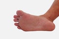 The under foot is a fungal infection. It is an actual skin