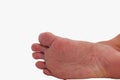 The under foot is a fungal infection. It is an actual skin Royalty Free Stock Photo