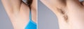 Before after underarm hair removal, female hairy armpit, clean skin after shaving