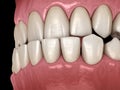 Underbite dental occlusion Malocclusion of teeth . Medically accurate tooth illustration