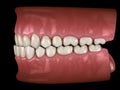 Underbite dental occlusion Malocclusion of teeth . Medically accurate tooth 3D illustration