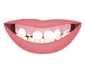 Kids mouth with a too big mandible and high smile line or gummy smile before the orthotropics or orthotropics treatment