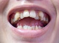 Malocclusion, Overcrowding of both upper and lower teeth Royalty Free Stock Photo