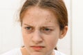 Unhappy face of a teenage girl with pimples, poor condition, acne on the skin, bags under the eyes, she looks at herself in the Royalty Free Stock Photo