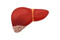 Unhealthy liver cancer. Human exocrine gland organ tumor destruction concept. Vector oncology illustration