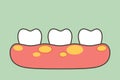 Unhealthy teeth because gingivitis or gum disease with abscess in gum