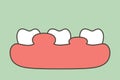 Unhealthy teeth because gingivitis or gum disease with abscess, gum is swollen