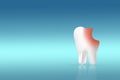 Unhealthy tooth white molar model on pastel blue background. Tooth symbol sign. Caries. Caries and disease of tooth. Unhealthy