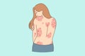 Unhealthy woman show red rash on back