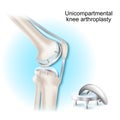 Unicompartmental knee arthroplasty