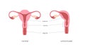 Unicornuate and normal healthy uterus comparison chart. Congenital malformation of female reproductive system.