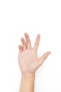 Unilateral DupuytrenÃ¢â¬â¢s contracture in Asian young man. Unilateral hand abnormality