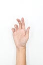 Unilateral DupuytrenÃ¢â¬â¢s contracture in Asian young man. Unilateral hand abnormality