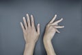 Unilateral DupuytrenÃ¢â¬â¢s contracture in Asian young man. Unilateral hand deformity. Abnormal fingers flexion