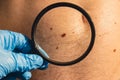 Unrecognizable Dermatologist examining patient& x27;s birthmark with magnifying glass in clinic. Mole dermoscopy Royalty Free Stock Photo