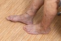 Unrecognizable senior woman bare legs with protruding varix, spider varicose veins medical condition. Vascular medicine