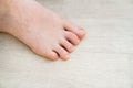 unusual foot. very small little finger on the leg. orthopedic abnormalities. Royalty Free Stock Photo