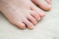 unusual foot. very small little finger on the leg. orthopedic abnormalities. Royalty Free Stock Photo