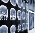 Unusual view of the MRI, X-ray images of the patient during disc Royalty Free Stock Photo