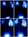 Renal hydronephrosis nuclear medicine