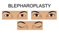 Upper eyelid blepharoplasty