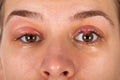 Upper eyelid infection - chalazion Royalty Free Stock Photo