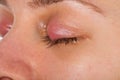 Upper eyelid infection - chalazion Royalty Free Stock Photo