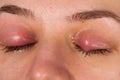 Upper eyelid infection - chalazion Royalty Free Stock Photo