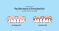 Upper healthy teeth & Periodontitis illustration vector