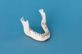 Upper human jaw without teeth model medical implant isolated on blue background. Healthy teeth, dental care and Royalty Free Stock Photo