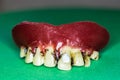 Upper jaw prosthesis Royalty Free Stock Photo