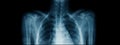 Upper part x-ray image Royalty Free Stock Photo