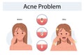 Upset woman with facial skin problem. infographic of acne disease and stages of treatment. Before and after. Vector illustration.v