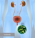 Urethritis is the inflammation of the urethra. Gonococcal urethritis. Urinary tract infection.