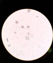 Uric Acid crystals in urine