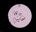 Uric acid in urine sediment.Uric acid is made from the natural b