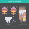 Urinary Incontinence. Urine filling cone device.