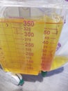 Foley catheter reservoir filled with yellow urine