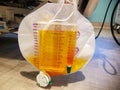 Foley catheter reservoir filled with yellow urine