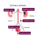 Urinary stones ( Kidney stones ) illustration Royalty Free Stock Photo