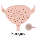 Urinary tract infection. Fungus