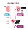 Urinary tract infection illustration