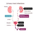 Urinary tract infection illustration Royalty Free Stock Photo